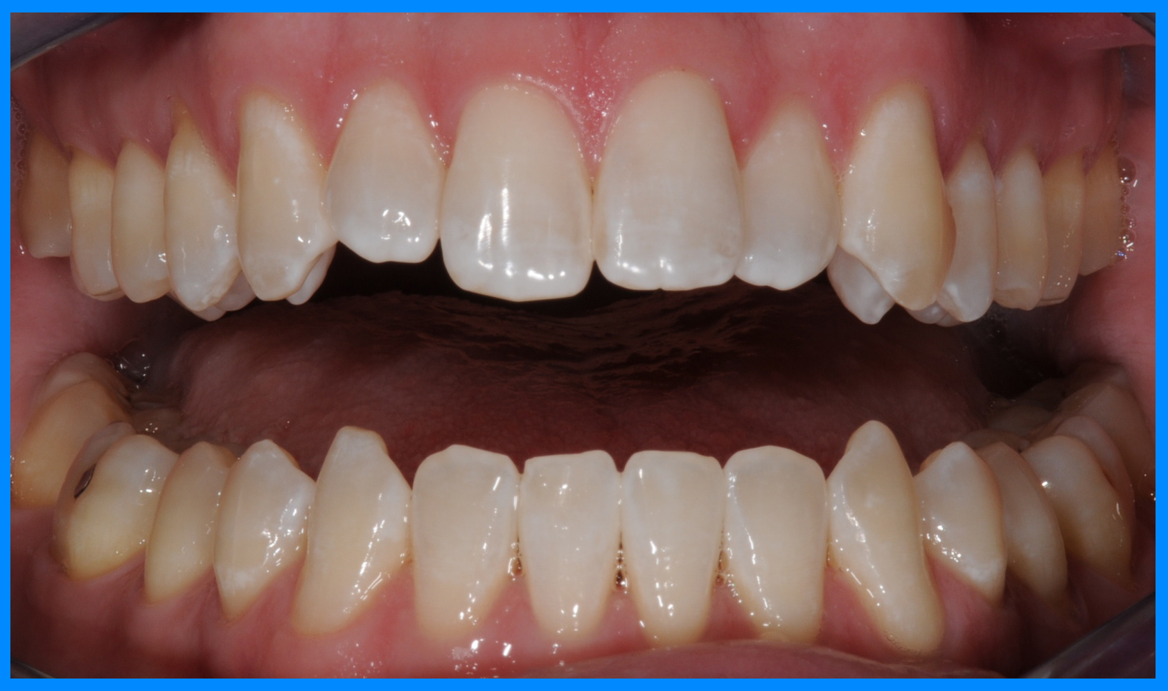 brevard county teeth whitening after