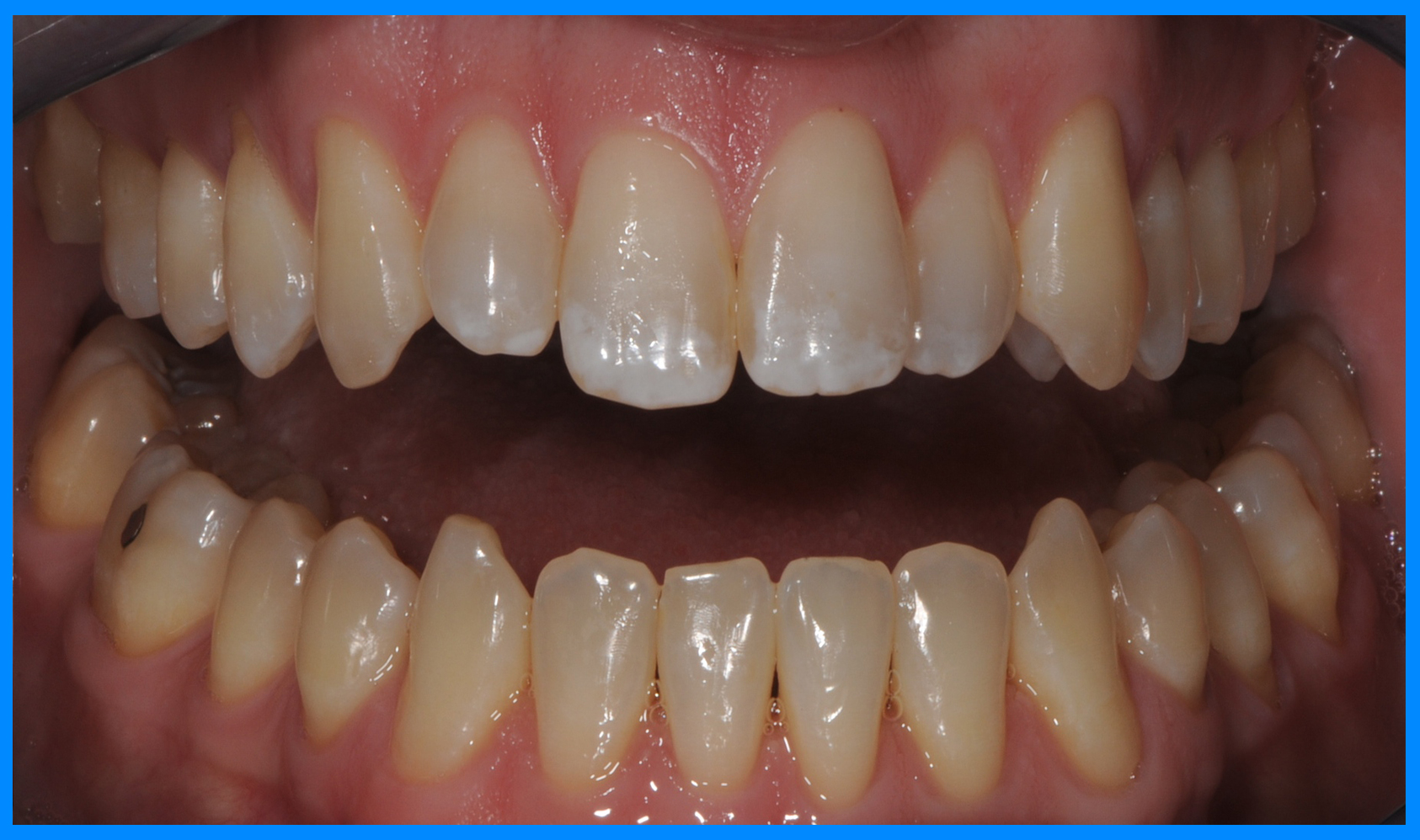 brevard county teeth whitening before