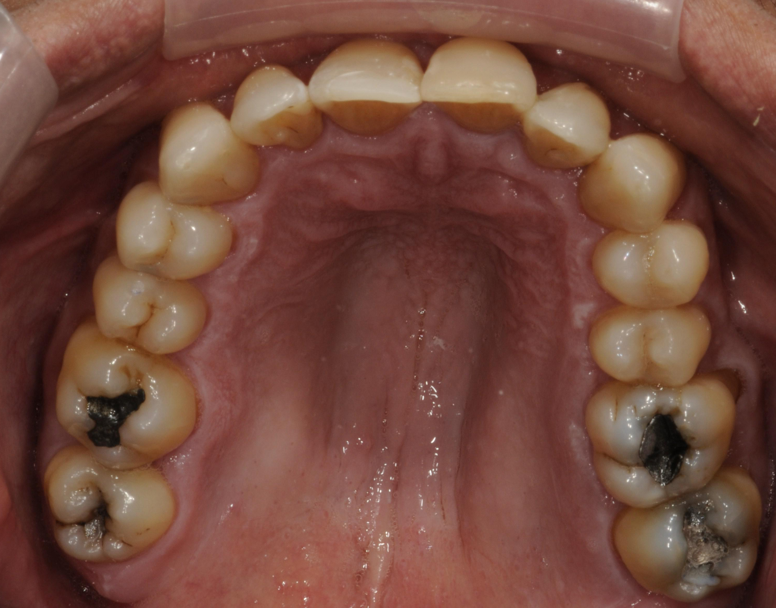 invisalign after